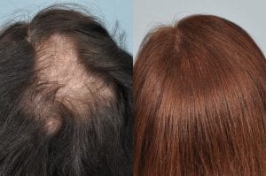 hair-transplant-testimonial-uk-patient-jan-2013