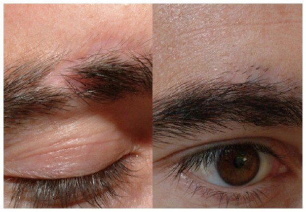 eyebrowtransplant