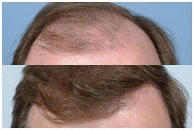 Hair transplant before and after photos