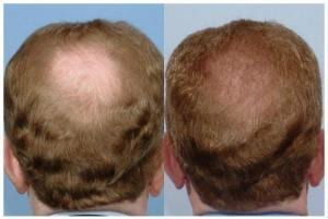 What causes hair loss in men