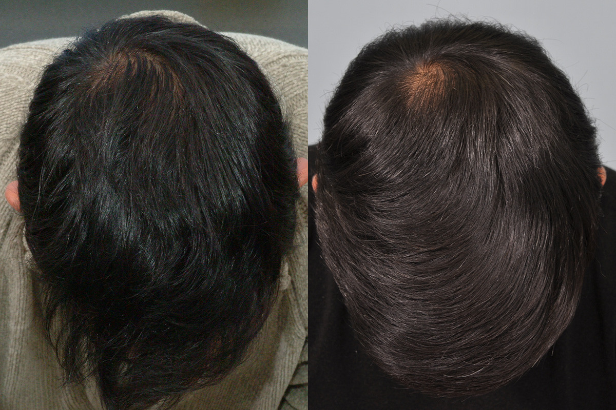 hair loss medicine results after 10 years 2005 - 2015