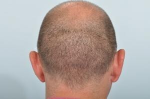 FUE hair transplant scar