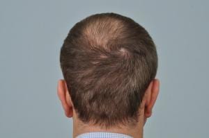 FUT hair transplant Donor Area after surgery