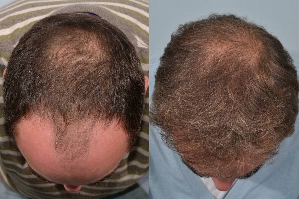 James Nesbitt hair transplant at HRBR - Before and After