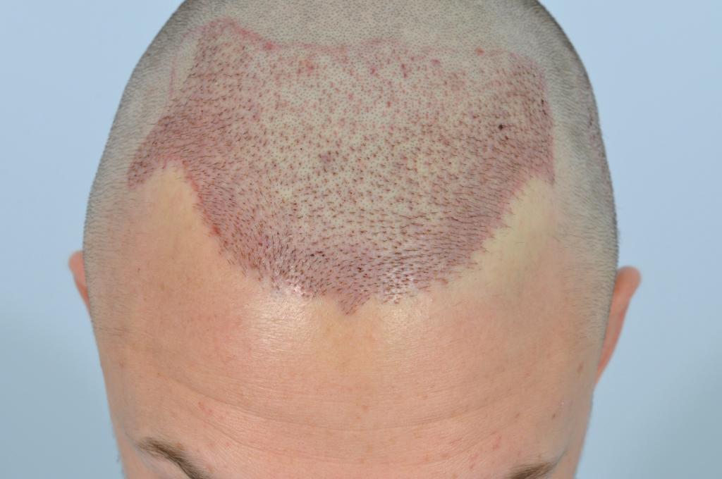 How a person should look immediately after a hair transplant