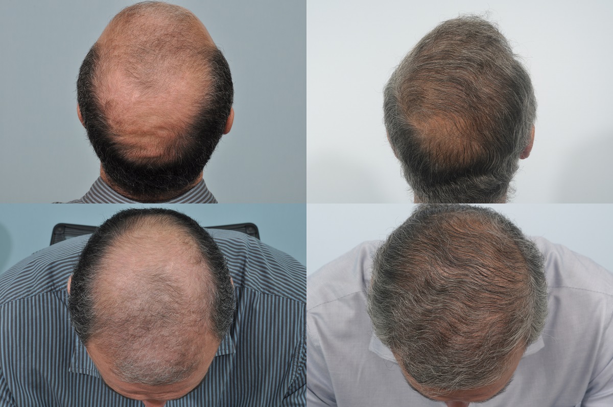 Before and after - 10 years post hair transplant