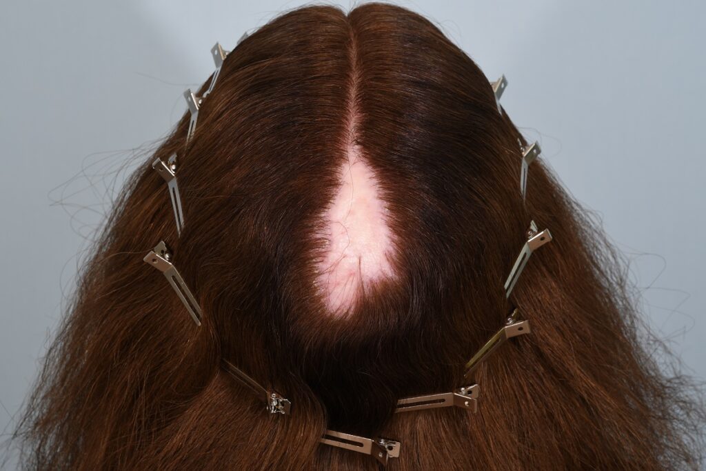 Scarring alopecia in a female patient before treatment. 